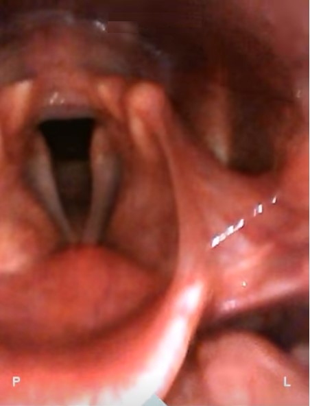 Dla porównania - niepowiększony obraz z badania krtani z poprzedniego modelu urządzenia